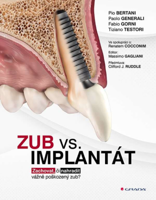Zub vs. implantát